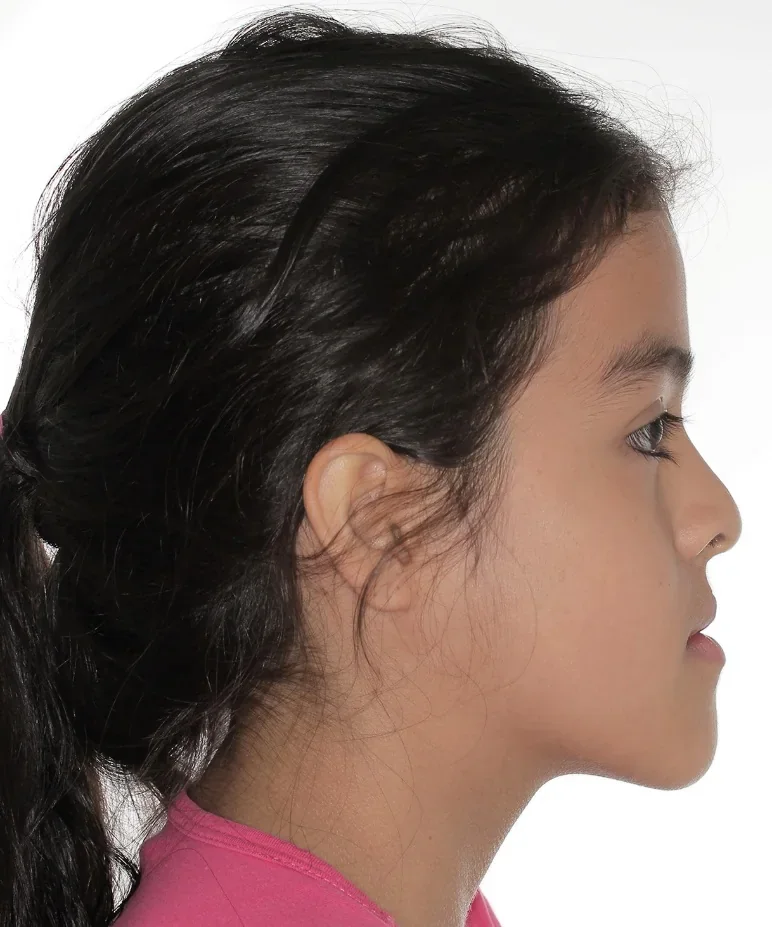 Perfil de María Isabel a los 11 años, al inicio del tratamiento